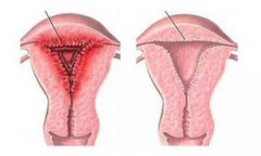 子宫内膜炎为何